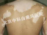 后背居然有白癜风