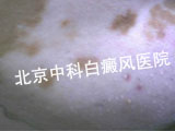 白癜风该如何护理